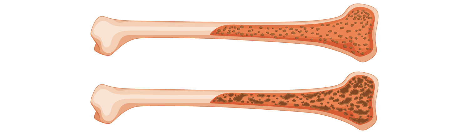 Programa Cribatge Osteoporosi Creu Groga